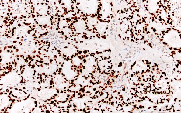 100B Metastasis, mucinous lung CA (Case 100) TTF1 40X