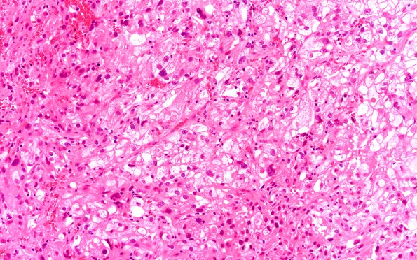 101A1 Metastasis, renal cell (Case 101) H&E 20X