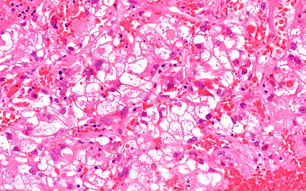 101A2 Metastasis, renal cell (Case 101) H&E 40X