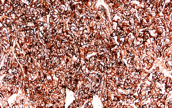 101B Metastasis, renal cell (Case 101) CAM5 E