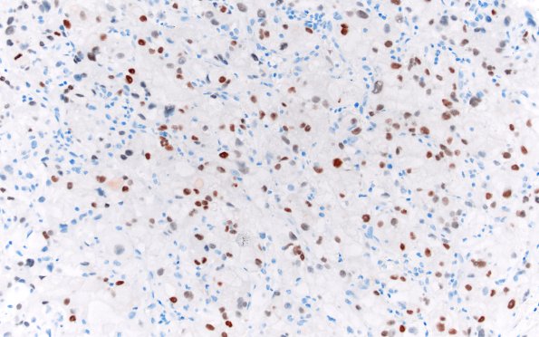 101D Metastasis, renal cell (Case 101) Pax-8 20X