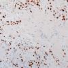 102E2 Met, breast AdenoCA & Sq metaplasia (Case 102) p40 20X 3