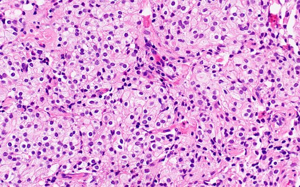 11A1 Metastasis, prostate (spinal cord) (Case 11) H&E 40X