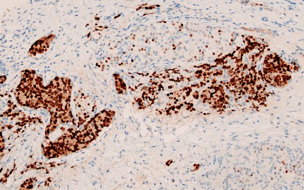 11A2 Metastasis, prostate (spinal cord) (Case 11) NKX3.1 1