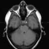 13A1 Metastases, medullary thyroid CA (Case 13) T1W  - Copy