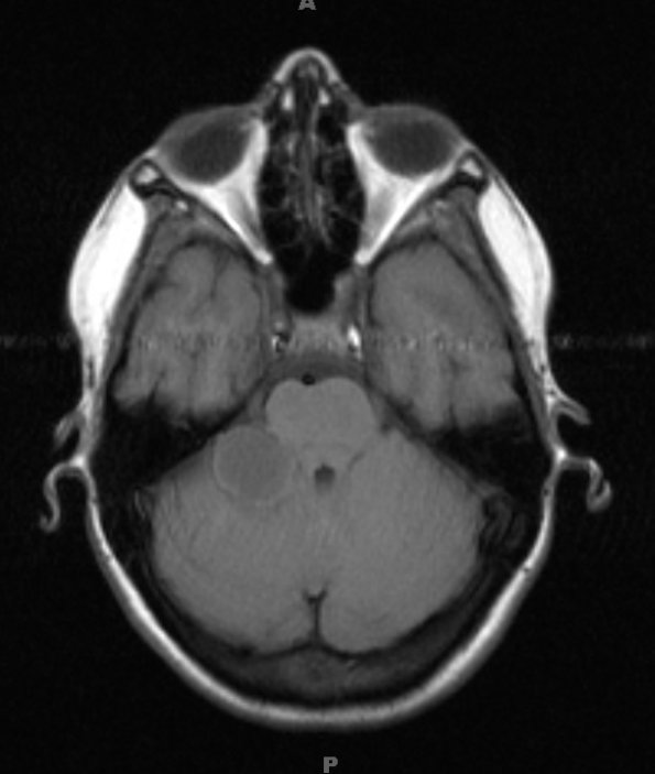 13A1 Metastases, medullary thyroid CA (Case 13) T1W  - Copy