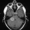 13A2 Metastases, medullary thyroid CA (Case 13) T1W  - Copy