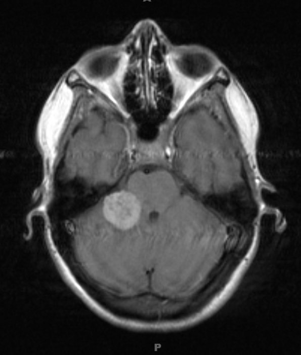 13A2 Metastases, medullary thyroid CA (Case 13) T1W  - Copy