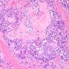 13B1 Metastases, medullary thyroid CA (Case 13) H&E - Copy (2).jpg