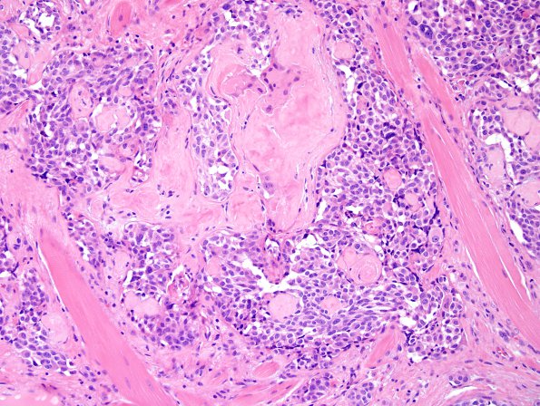 13B1 Metastases, medullary thyroid CA (Case 13) H&E - Copy (2).jpg