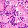 13B2 Metastases, medullary thyroid CA (Case 13) H&E - Copy (7).jpg