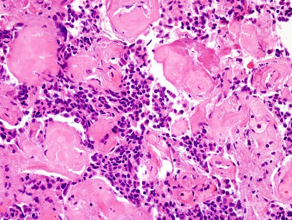 13B2 Metastases, medullary thyroid CA (Case 13) H&E - Copy (7).jpg