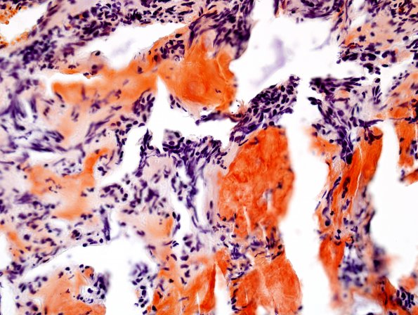 13C1 Metastases, medullary thyroid CA (Case 13) Cong - Copy.jpg