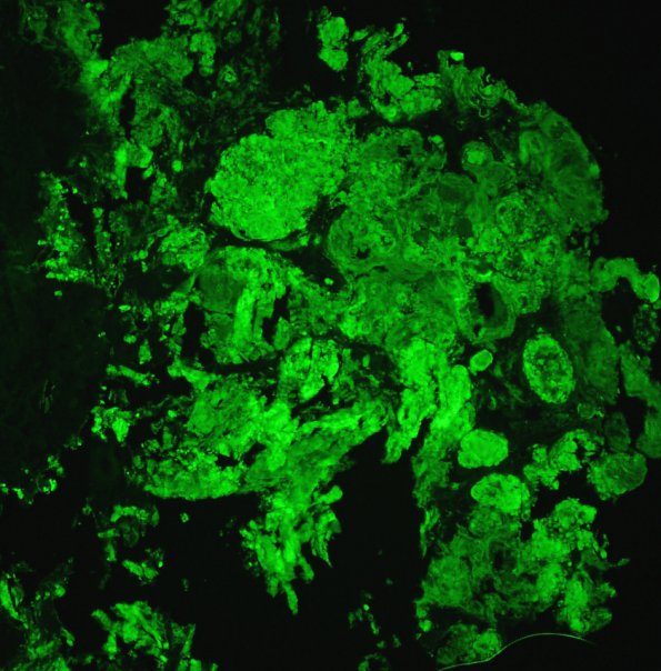 13D Metastases, medullary thyroid CA (Case 13) Thio-S 4