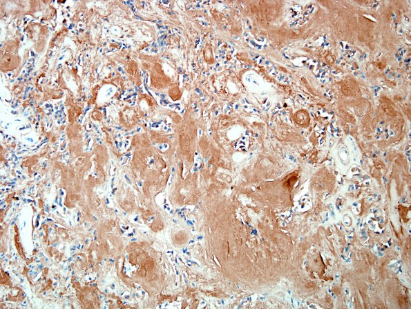 13E Metastases, medullary thyroid CA (Case 13) Calc - Copy.jpg