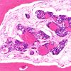 14A Metastasis, frontal bone, medullary thyroid origin (Case 14) H&E 3