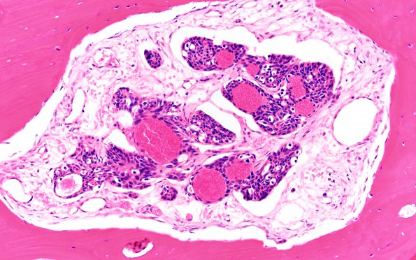 14A Metastasis, frontal bone, medullary thyroid origin (Case 14) H&E 3