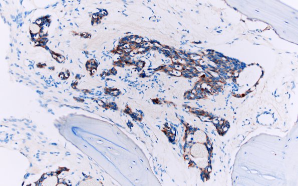 14B Metastasis, frontal bone, medullary thyroid origin (Case 14) pan-CK