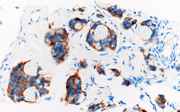 14C Metastasis, frontal bone, medullary thyroid origin (Case 14) Synaptophysin 1