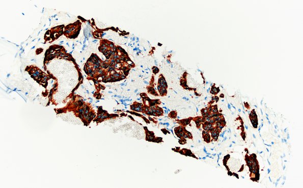 14D1 Metastasis, frontal bone, medullary thyroid origin (Case 14) Calcitonin 20X