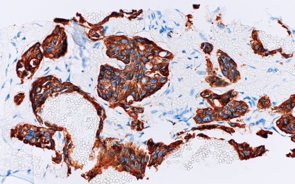 14D2 Metastasis, frontal bone, medullary thyroid origin (Case 14) Calcitonin 40X