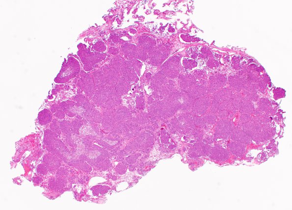 15A1 Metastasis, medullary thyroid (Case 15) H&E 1 - Copy