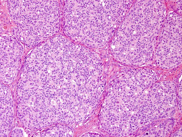 15A2 Metastasis, medullary thyroid cancer (Case 15) - Copy (4).jpg