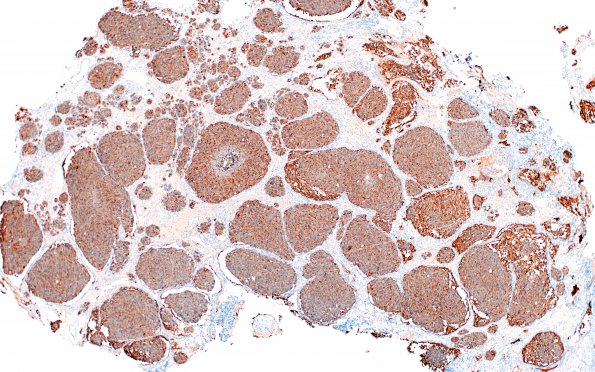 15B1 Metastasis, medullary thyroid (Case 15) calcitonin 2