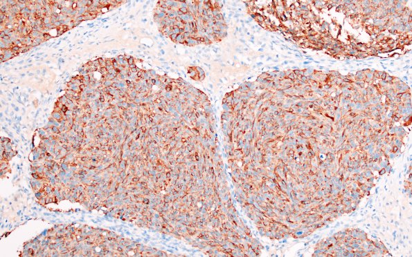 15B2 Metastasis, medullary thyroid (Case 15) calci - Copy