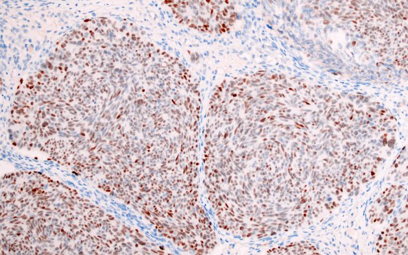 15C2 Metastasis, medullary thyroid (Case 15) TTF-1 - Copy