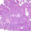 16A1 Metastasis, papillary thyroid CA (Case 16) H&E - Copy (4)