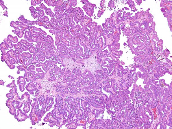 16A1 Metastasis, papillary thyroid CA (Case 16) H&E - Copy (4)