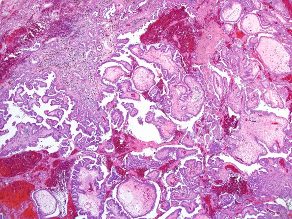 16A2 Metastasis, papillary thyroid CA (Case 16) H&E - Copy.jpg