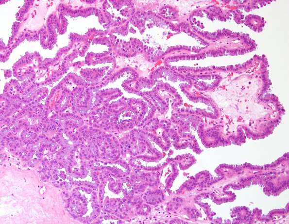 16A3 Metastasis, papillary thyroid CA (Case 16) H&E 20X.jpg