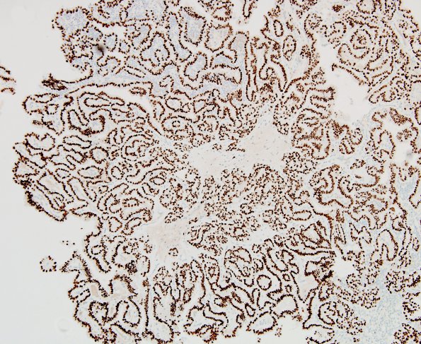 16B1 Metastasis, papillary thyroid CA (Case 16) PAX-8 10X