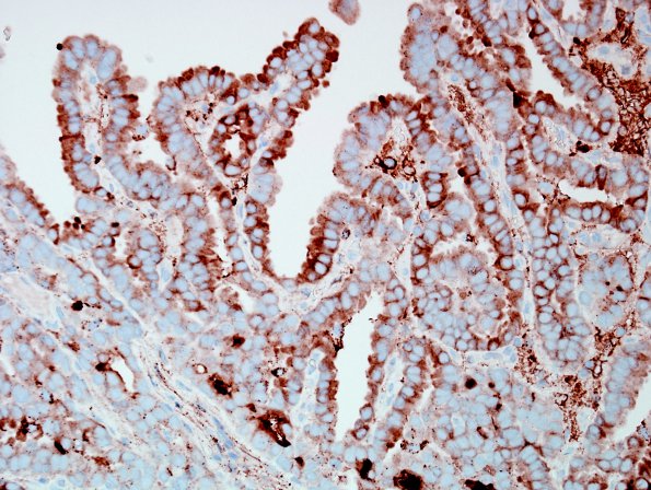 16C1 Metastasis, papillary thyroid CA (Case 16) Thy - Copy (2).jpg