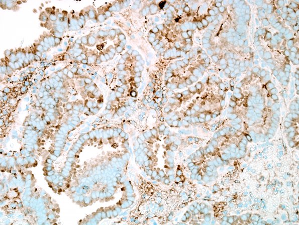 16C2 Metastasis, papillary thyroid CA (Case 16) Thyroglobulin 40X 2.jpg