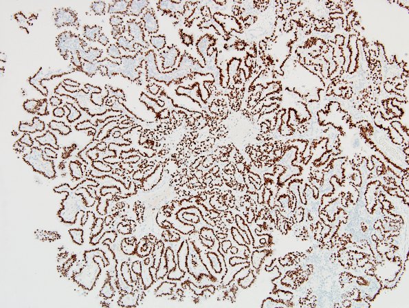 16D1 Metastasis, papillary thyroid CA (Case 16) TTF - Copy (2)