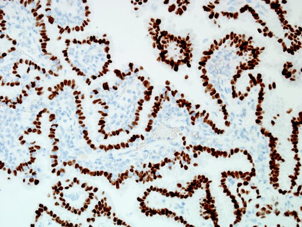 16D2 Metastasis, papillary thyroid CA (Case 16) TTF - Copy.jpg