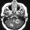 18A Metastases, ovarian (Case 18) T1 W 1