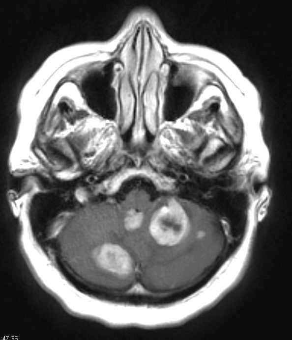 18A Metastases, ovarian (Case 18) T1 W 1