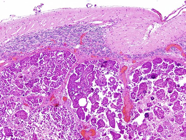 18B1 Metastases, ovarian (Case 18) H&E 2.jpg