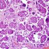 18B2 Metastases, ovarian (Case 18) H&E 3.jpg