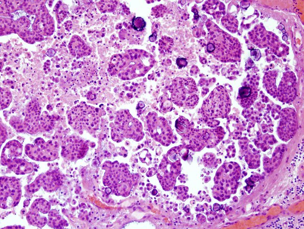 18B2 Metastases, ovarian (Case 18) H&E 3.jpg