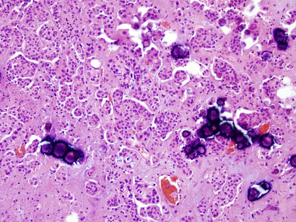 18B3 Metastases, ovarian (Case 18) H&E 4.jpg