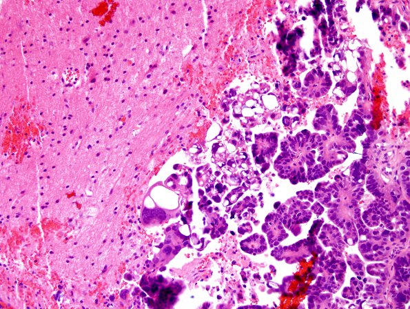 19B Metastasis, ovarian mullerian CA (Case 19) H&E 1.jpg