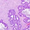 1A2 Metastasis, colon primary (Case 1) H&E 2.jpg