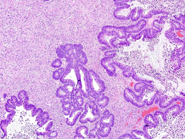 1A2 Metastasis, colon primary (Case 1) H&E 2.jpg