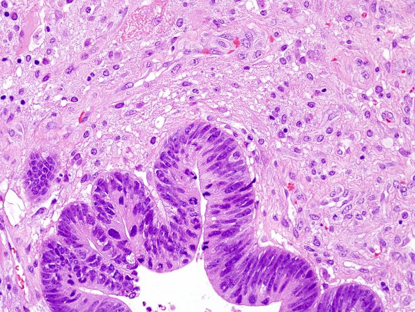 1A3 Metastasis, colon primary (Case 1) H&E 4.jpg