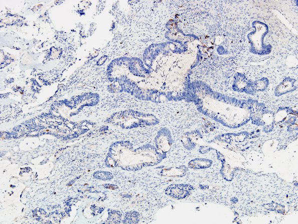 1B1 Metastasis, colon (Case 1) CK 7